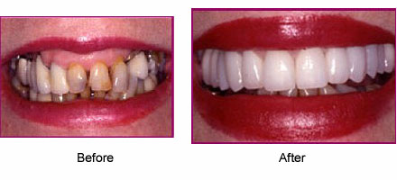 Before and after pictures of mouth/teeth